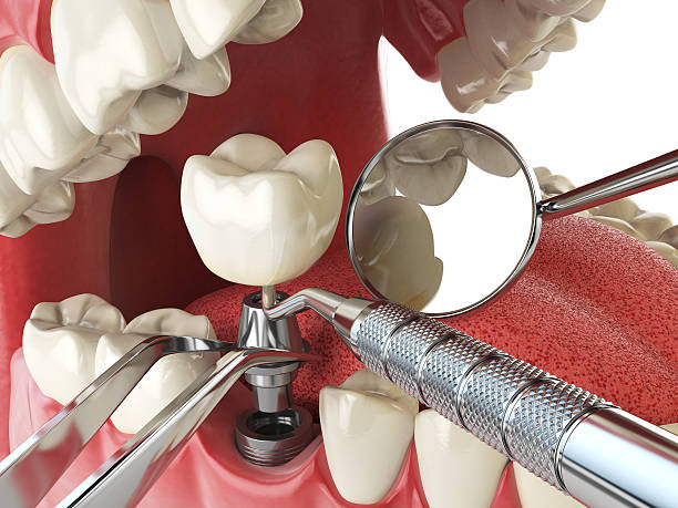 Best Broken or Chipped Tooth Repair in Arthurtown, SC